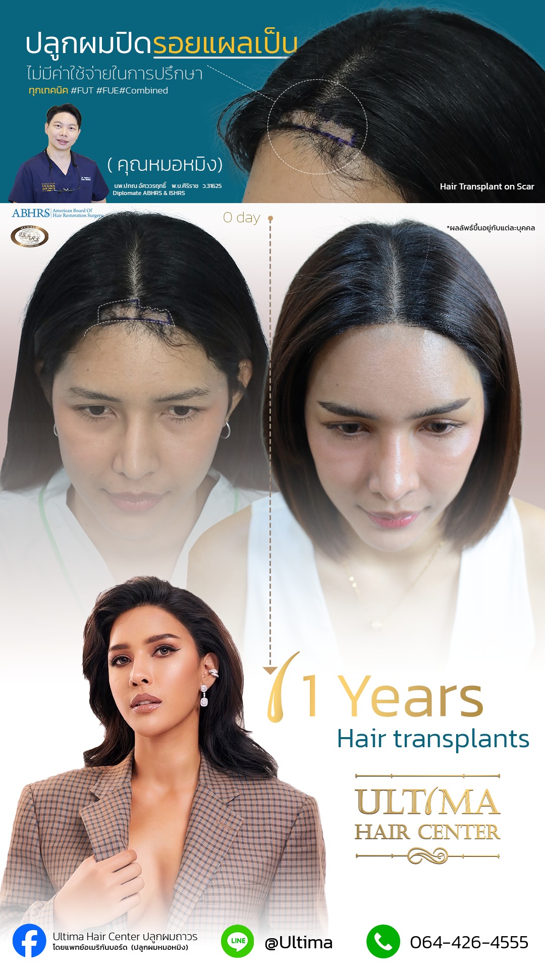 Ultima Hair Center ปลูกผมถาวร Facebook ad: สามารถทำได้