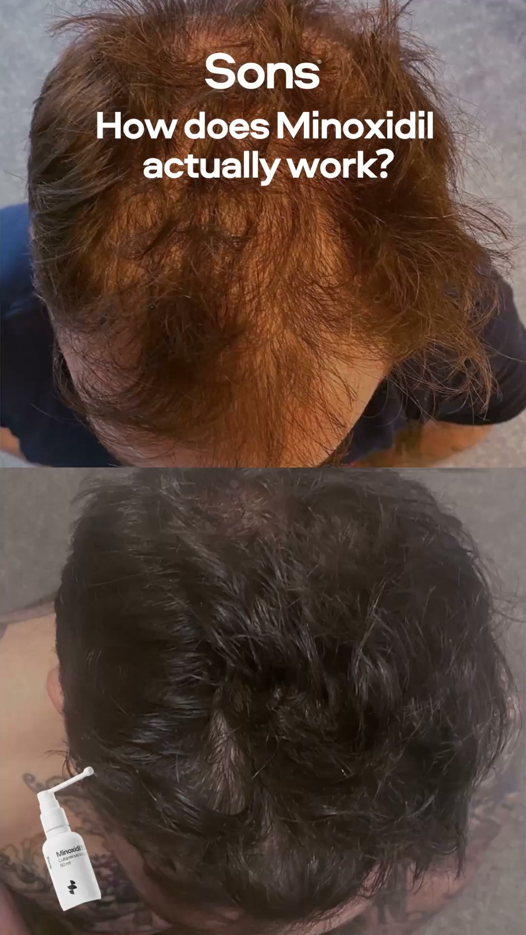 Sons Facebook ad: Your hairline. Your call.