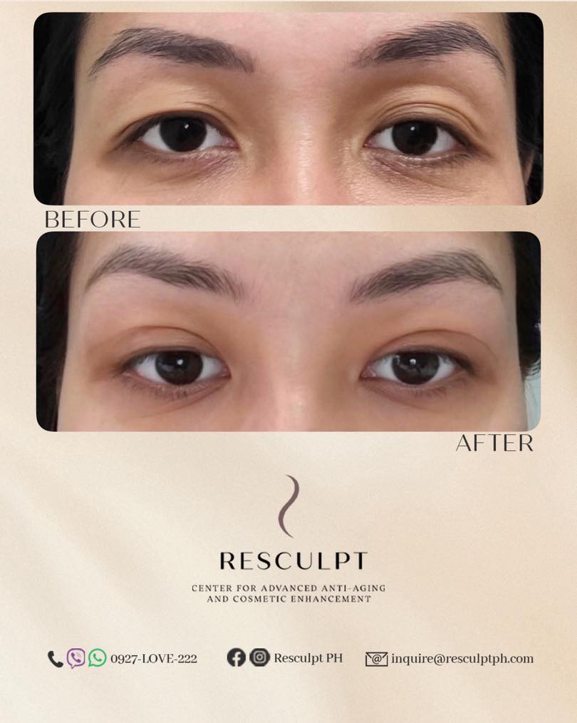 Resculpt PH Facebook ad: Say goodbye to asymmetrical eyelids!