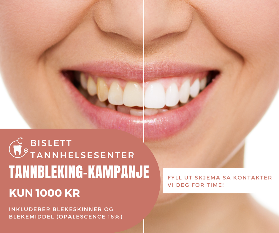 Bislett Tannhelsesenter Facebook ad: Tannbleking-Kampanje