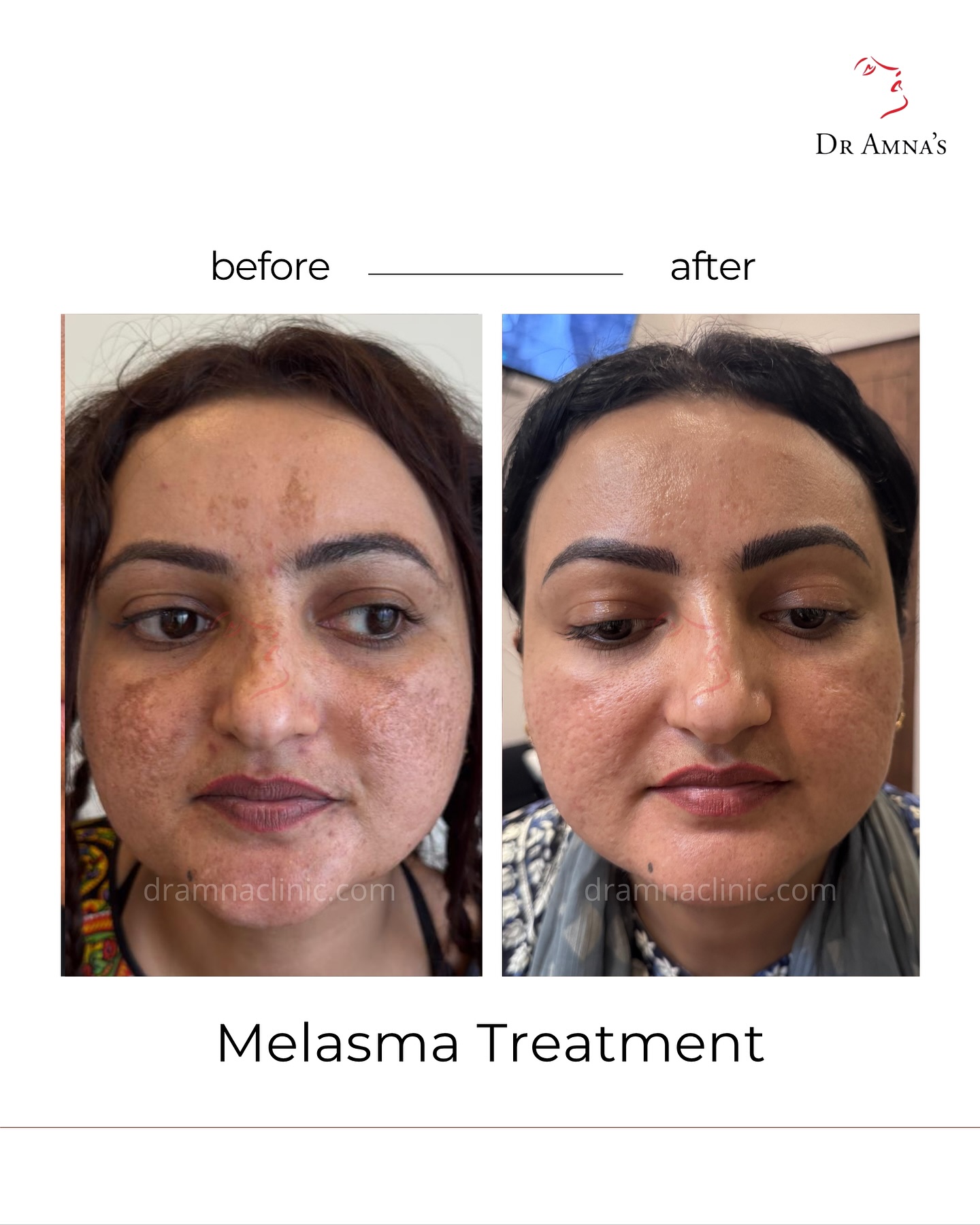 Dr. Amna's Skin Clinics Facebook ad: These results speak louder than any promise we…