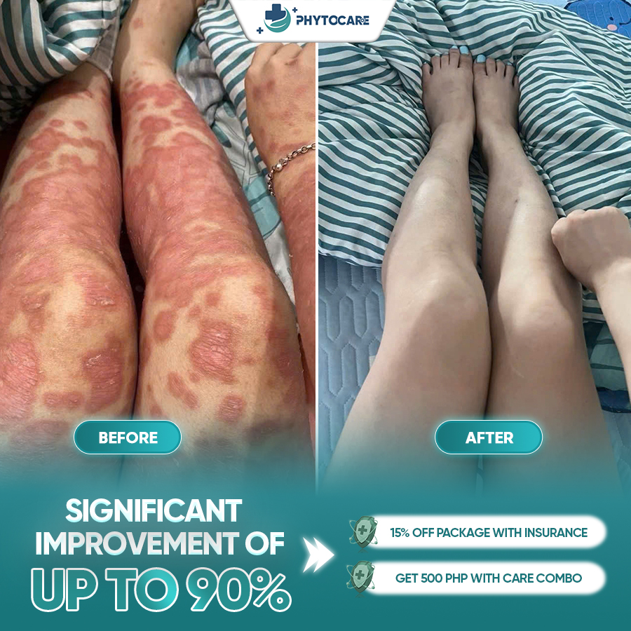 Cebu Phytocare Dermatology Clinic Facebook ad: ITCHING - FLAKING - REDNESS THAT JUST WON’T…