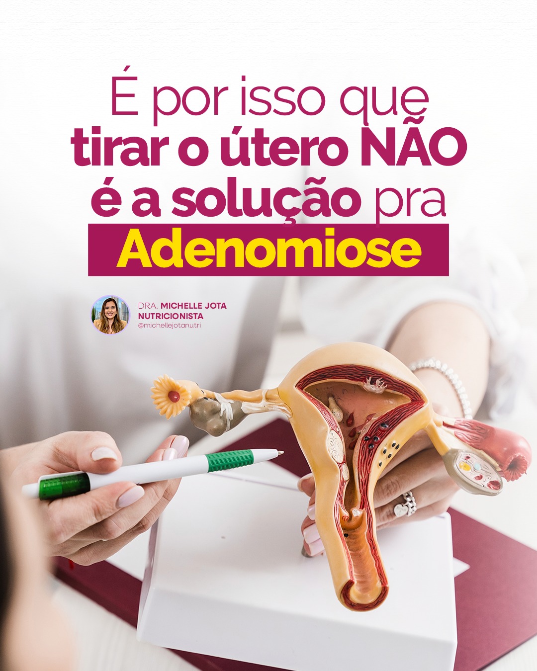Michelle Jota Facebook ad: A Adenomiose é uma doença inflamatória, e o…