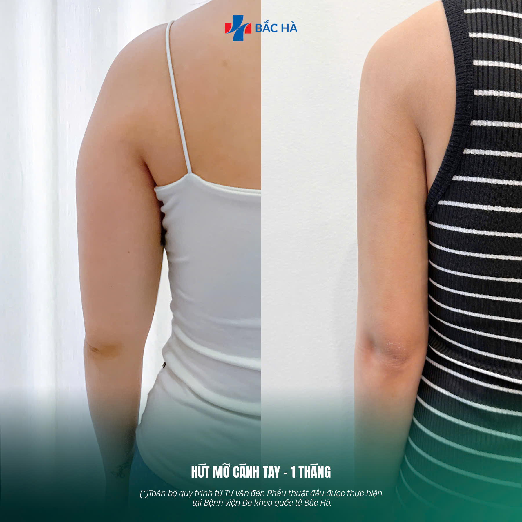 Sline - Khoa PTTM BV Bắc Hà Facebook ad: GIẢM 40% HÚT MỠ CÁNH TAY, TẶNG HÚT…