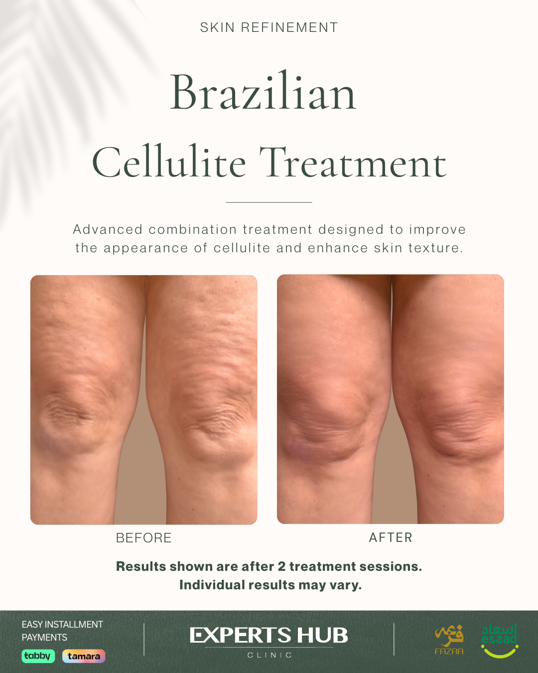 Kairon Polyclinic Facebook ad: Brazilian Cellulite Treatment