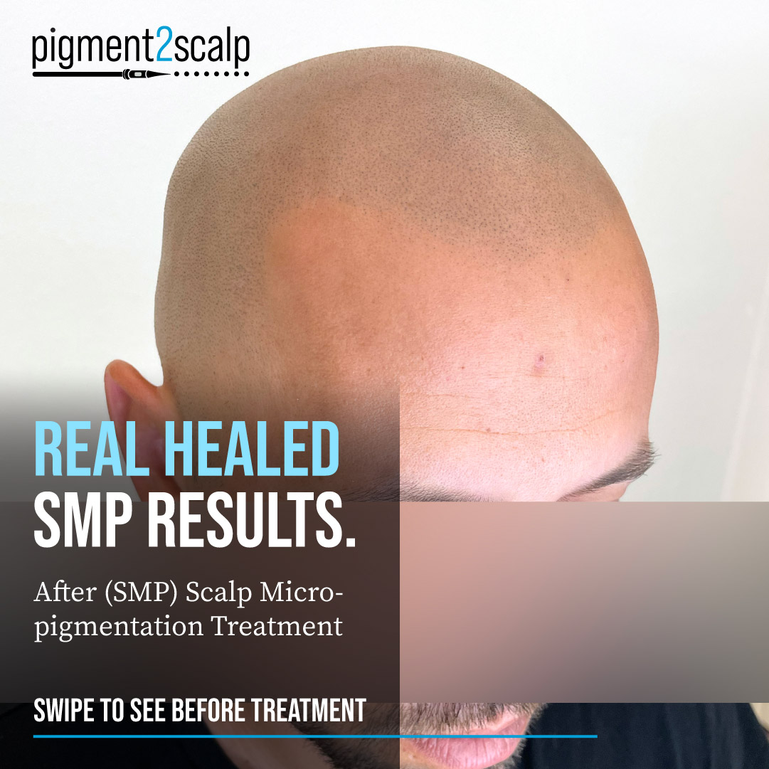 Pigment2scalp Micropigmentation Facebook ad: Natural-looking Scalp Micropigmentation is more than just…