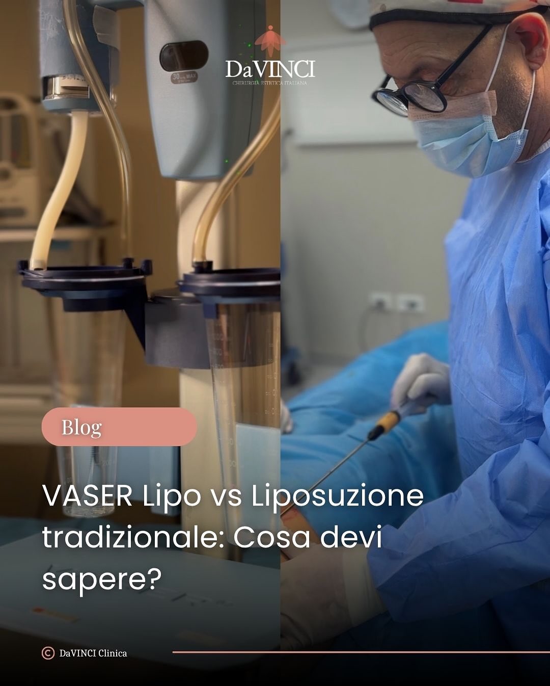 Chirurgia Estetica Italiana Facebook ad: VASER Lipo vs Liposuzione Tradizionale