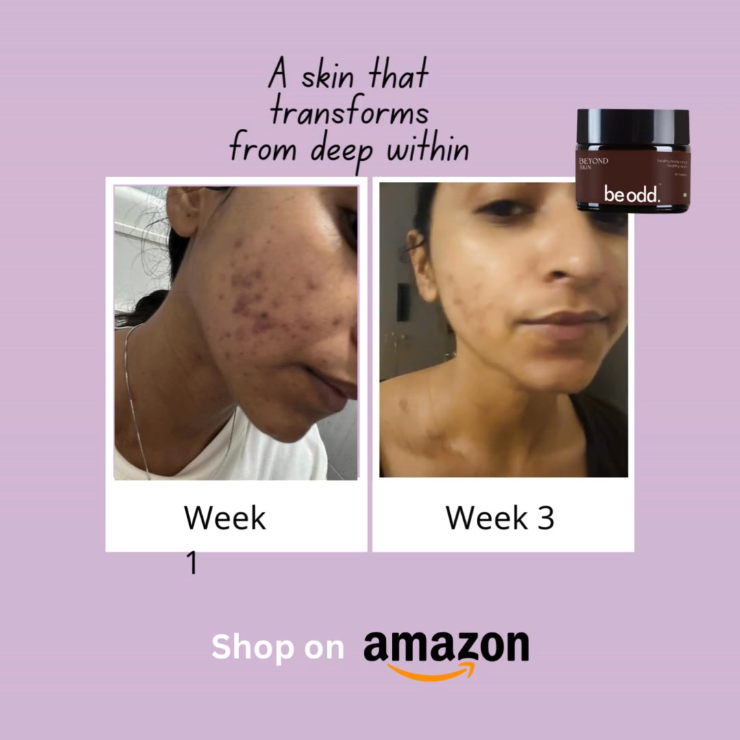 Be Odd Facebook ad: Guaranteed Pimple Free Skin for just Rs.