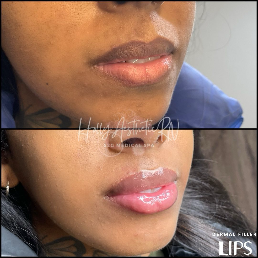 Holly Aesthetics RN Facebook ad: PDO THREADS for a Non-Surgical Facelift