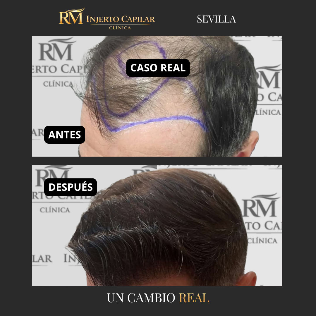 RM Injerto Capilar Facebook ad: Solicita tu valoración capilar gratuita