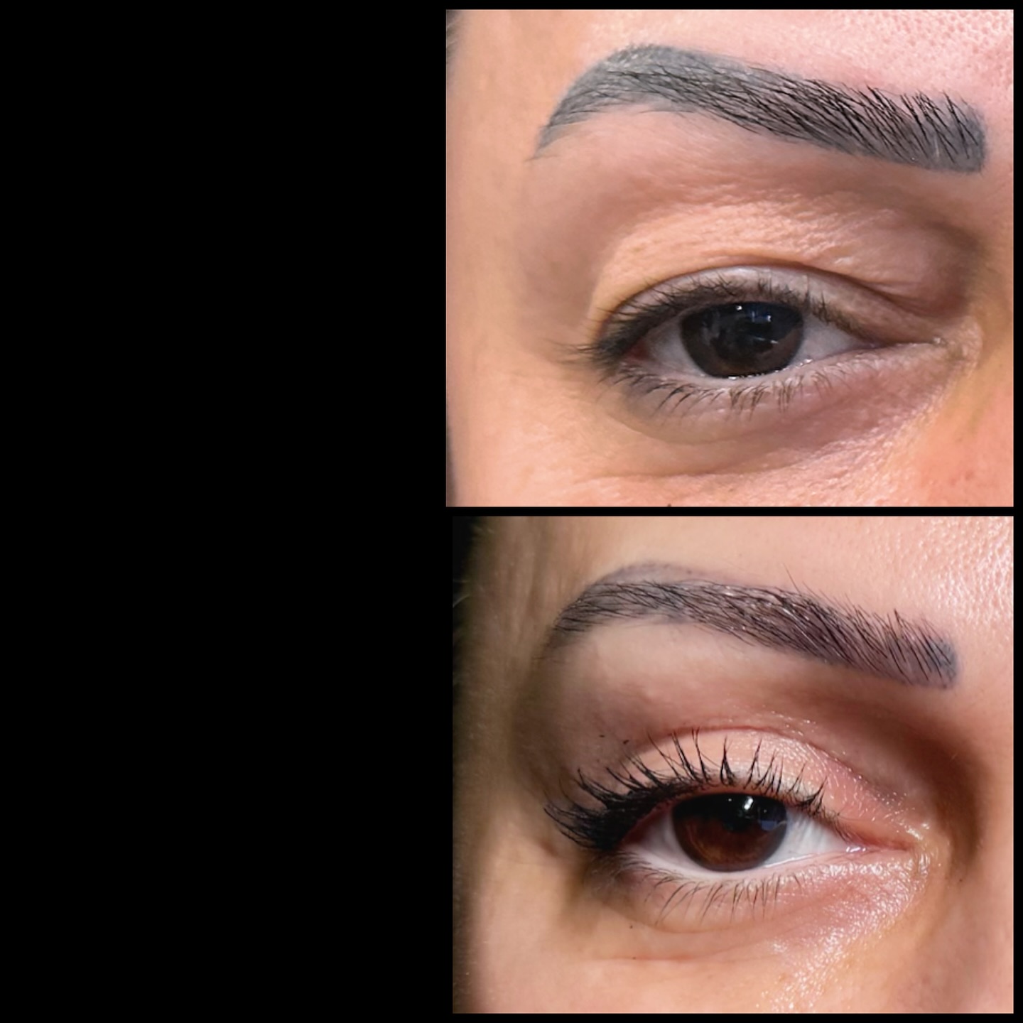 Baku Aesthetic Medicine Facebook ad: Upper eyelid surgery Üst blefaroplastika əməliyyatı