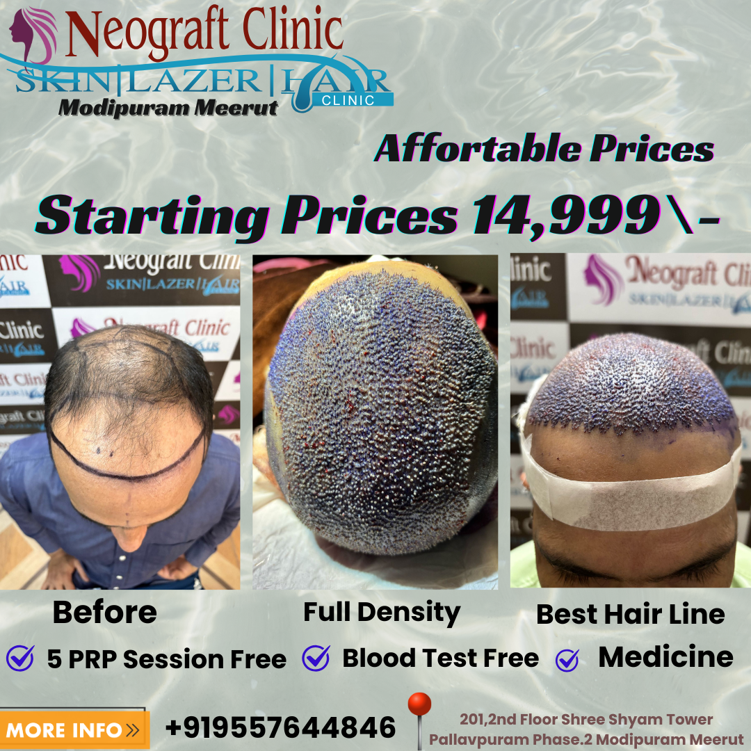 Neograft Skin & Hair Clinic Facebook ad: Hair Transplant Services In Modipuram