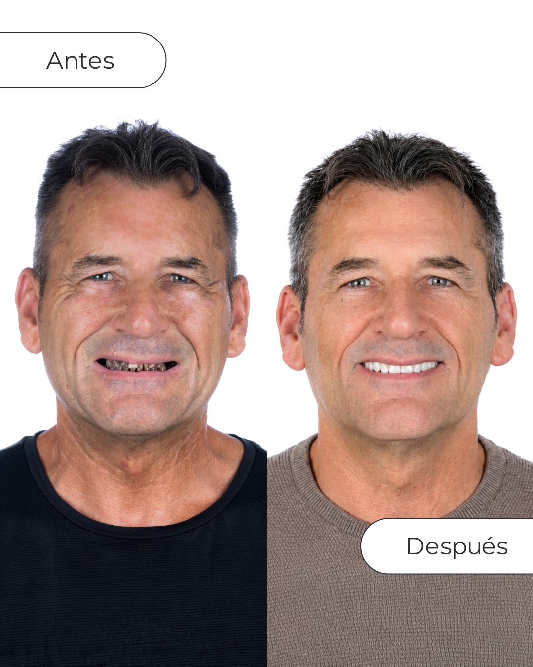 Vericat Implantología Inmediata. Clínica de implantes dentales. Facebook ad: El cambio de Ramón Isidro habla por sí…