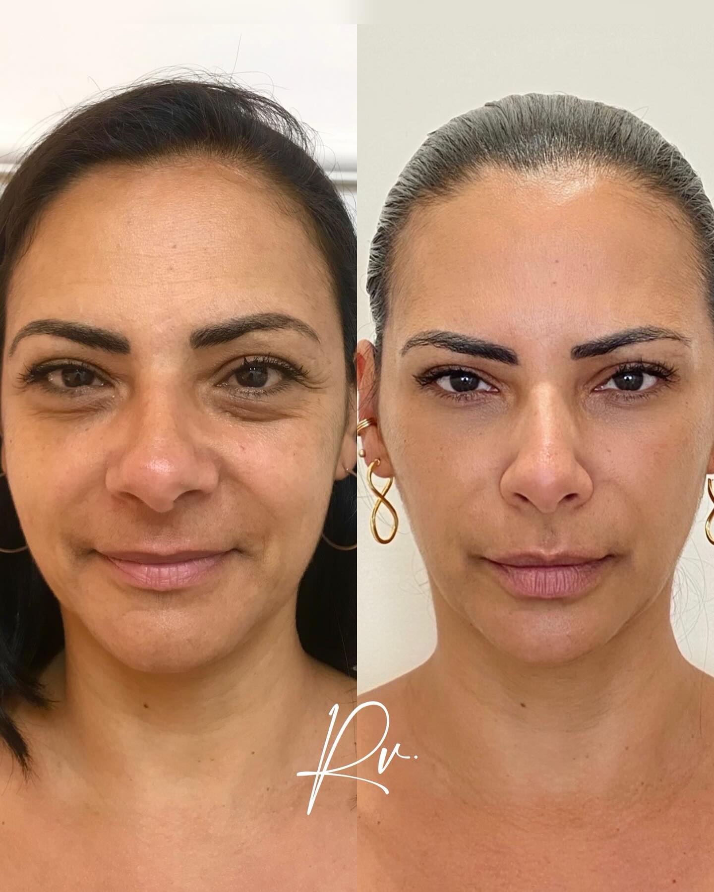 draraquelvasquez Facebook ad: Meu rosto está derretendo Dra Foi assim que…
