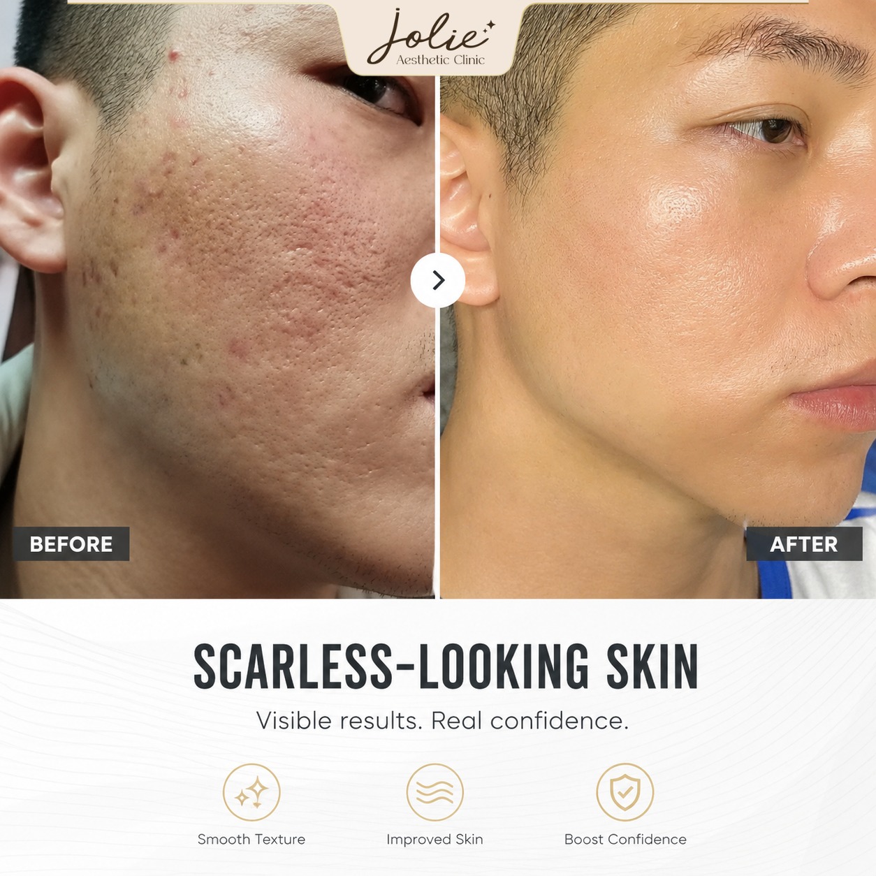 Jolie Ageless Beauty Johor Facebook ad: IMPROVE PITTED SCARS UP TO 80% AT JOLIE