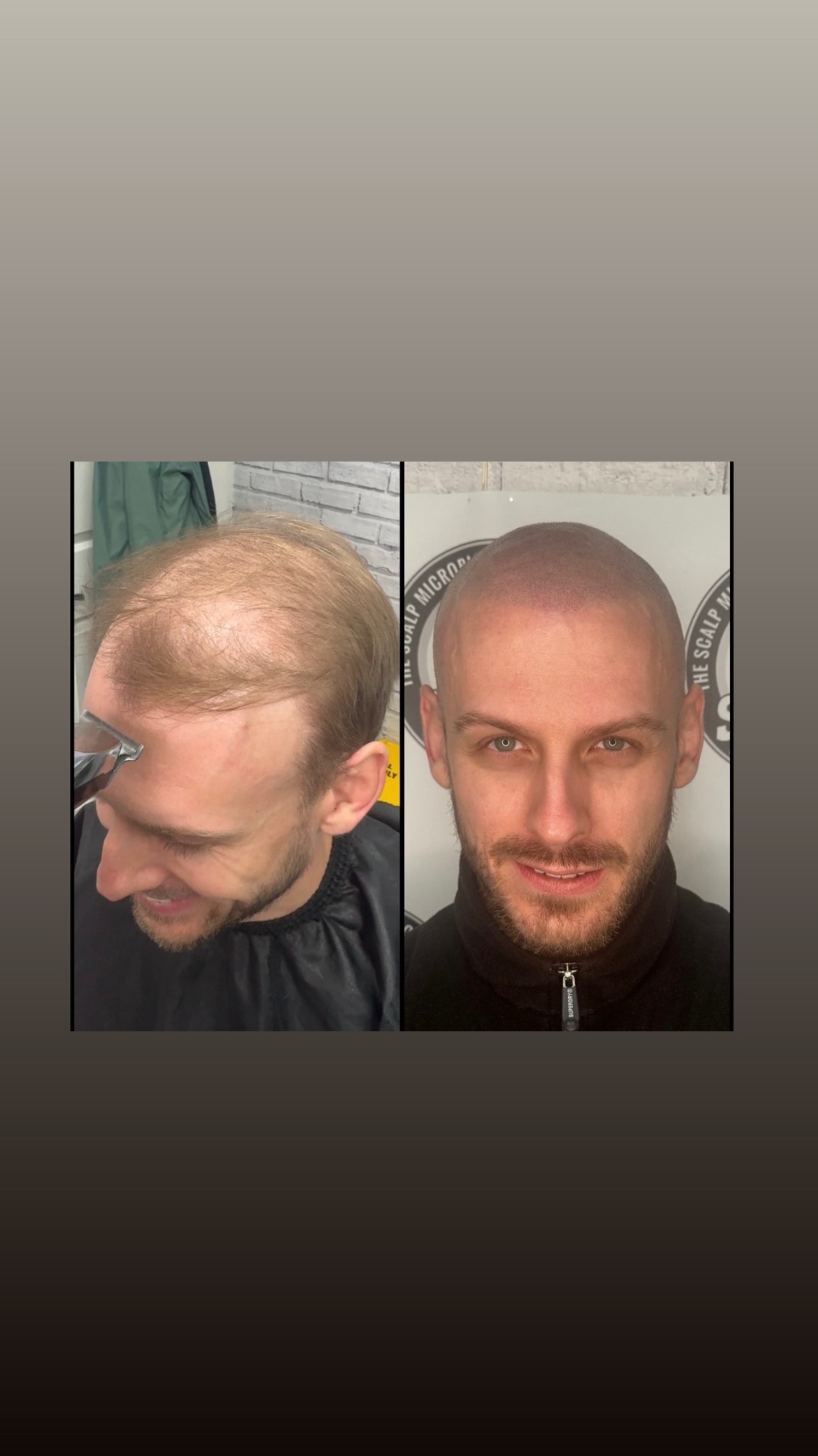 Scalp Inked Facebook ad: Scalp micropigmentation or SMP is the process of…