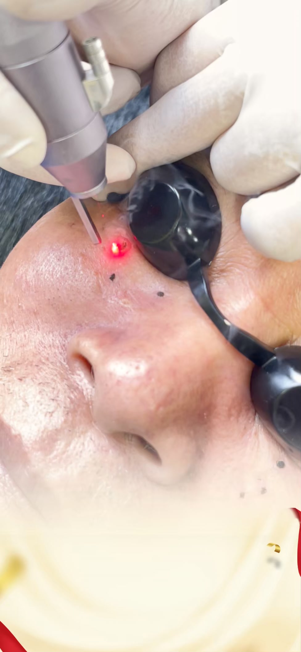 Lạc Trần - Trung tâm trị rạn da, sẹo lồi, lõm bằng laser Facebook ad: XOÁ NỐT RUỒI- MỤN THỊT- MỤN CÓC TẬN…