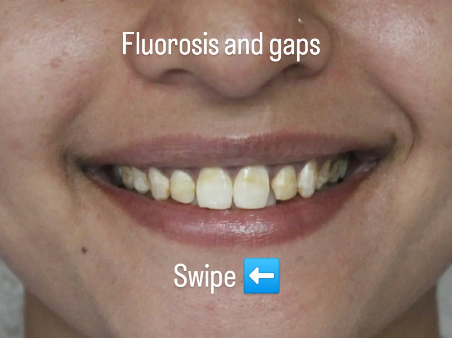 All Smiles Dental Clinic,Bangalore-center for cosmetic dentistry Facebook ad