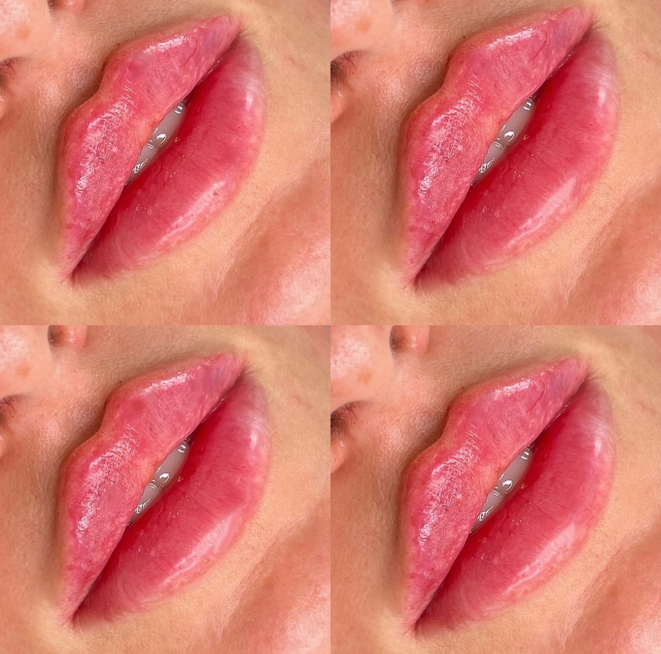Udermamedspa Facebook ad: INJECTABLES LASERS WELNESS (@alana_tampainjector) •…