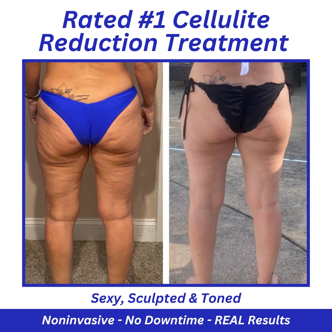 Mind & Body Renew Medical Spa and Psychiatry - 2nd page Facebook ad: 2-in-1 Bye Bye Cellulite Treatment NOW $199