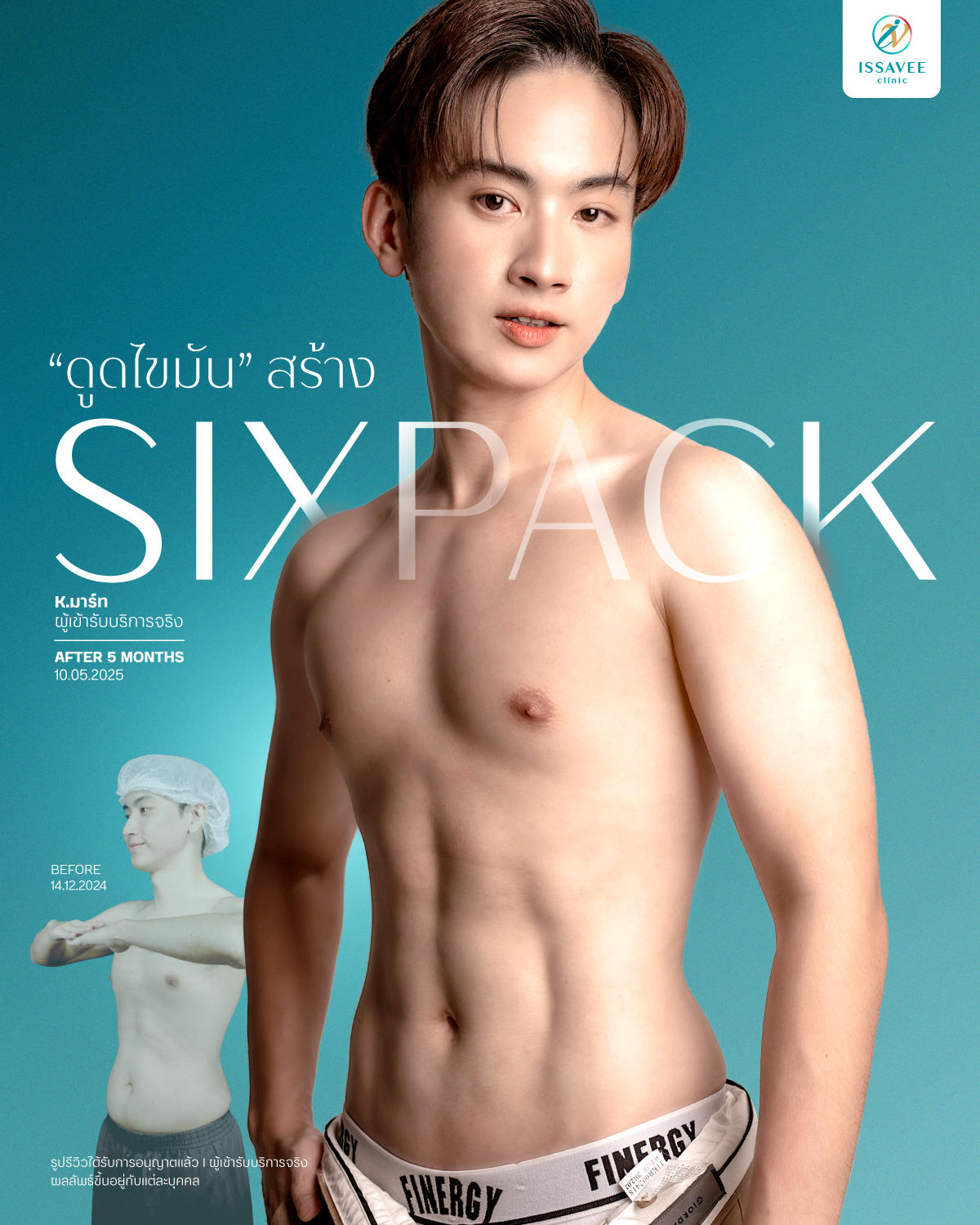ดูดไขมัน 360 FTL by Issavee Clinic Facebook ad