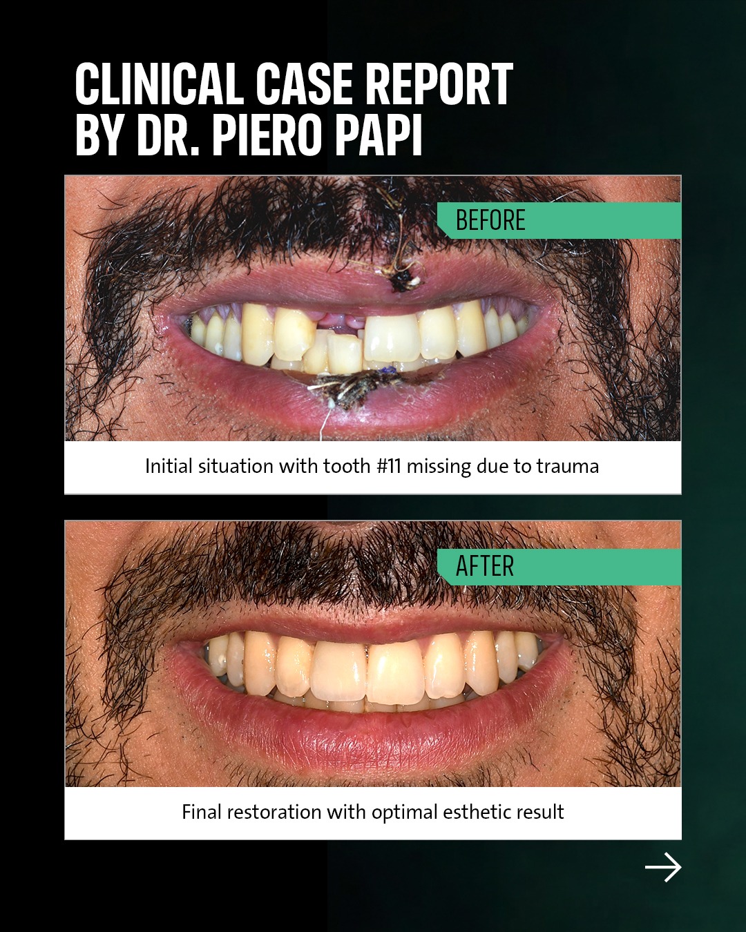 Straumann Facebook ad: A 35-year-old patient with traumatic avulsion of a…
