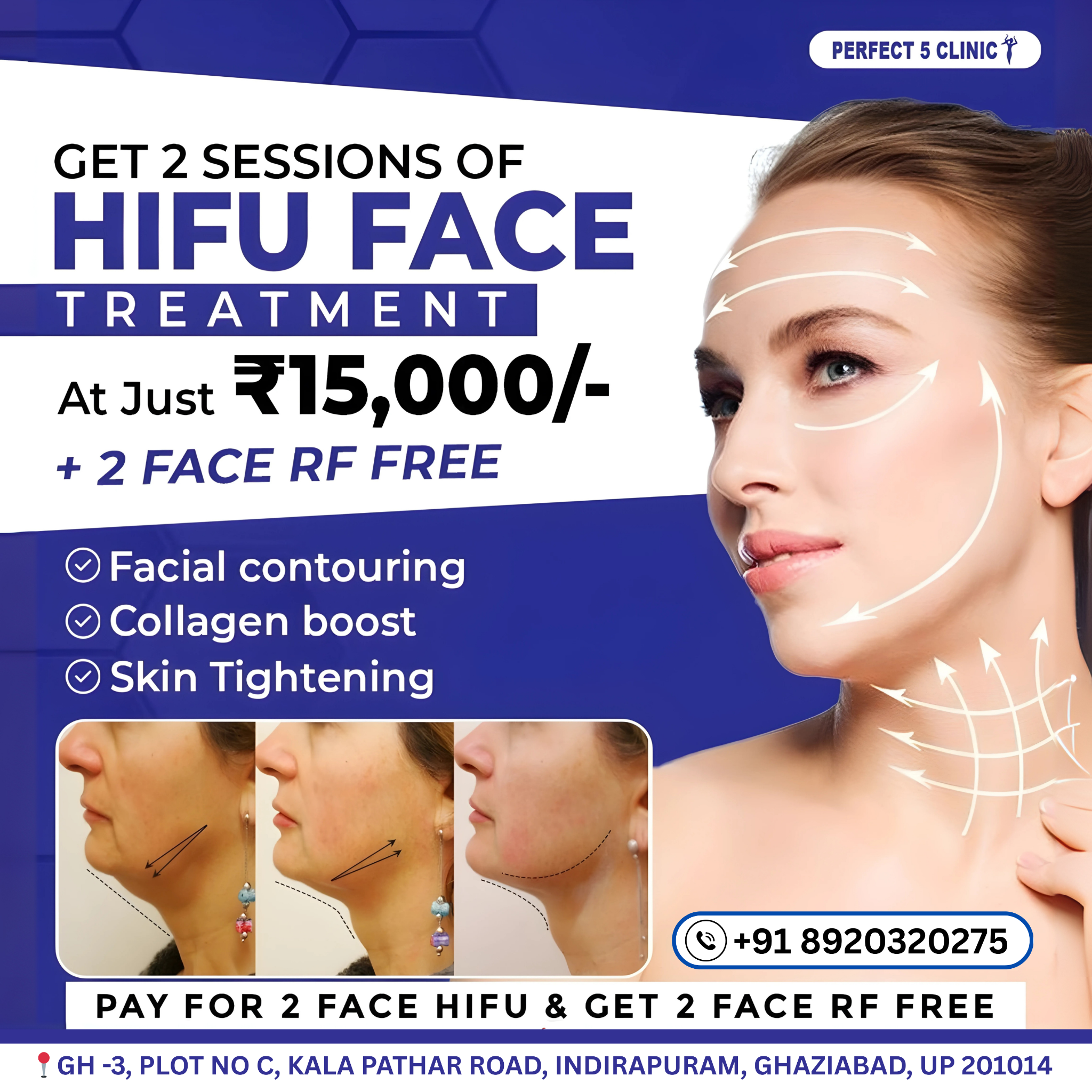Perfect 5 Clinic - Indirapuram Facebook ad: Lift, Tighten & Contour Your Face - Get 2 HIFU Treatments…