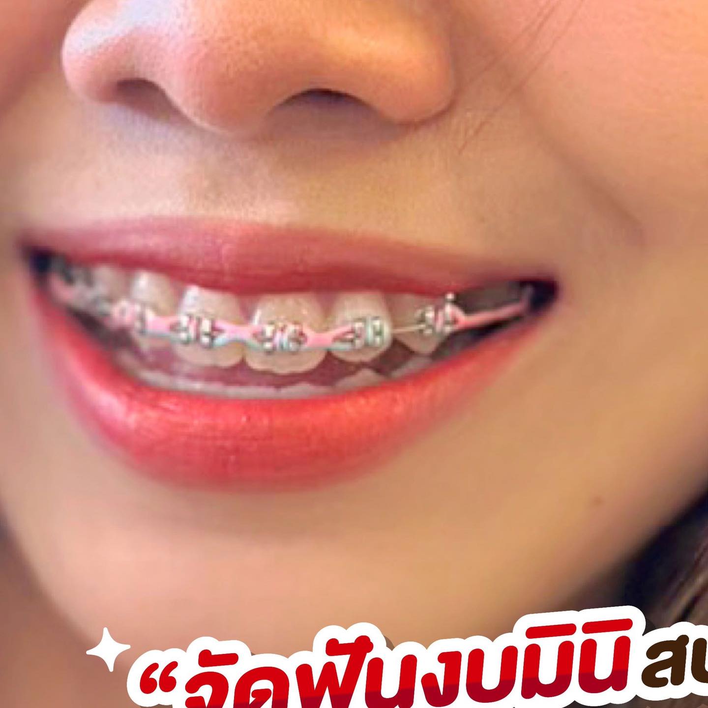 Itooth dental clinic ทันตกรรม ครบวงจร Facebook ad