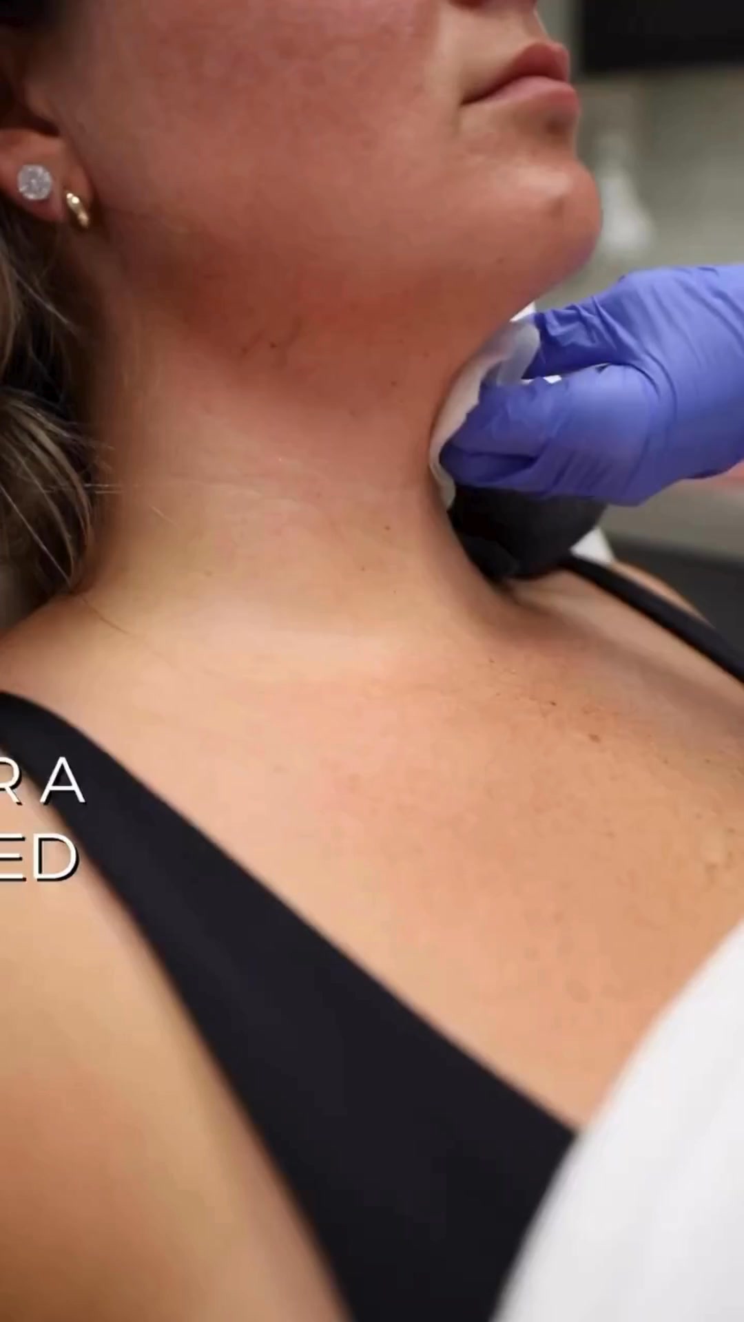 Pacific Derm Facebook ad: $150 OFF Your First Treatment