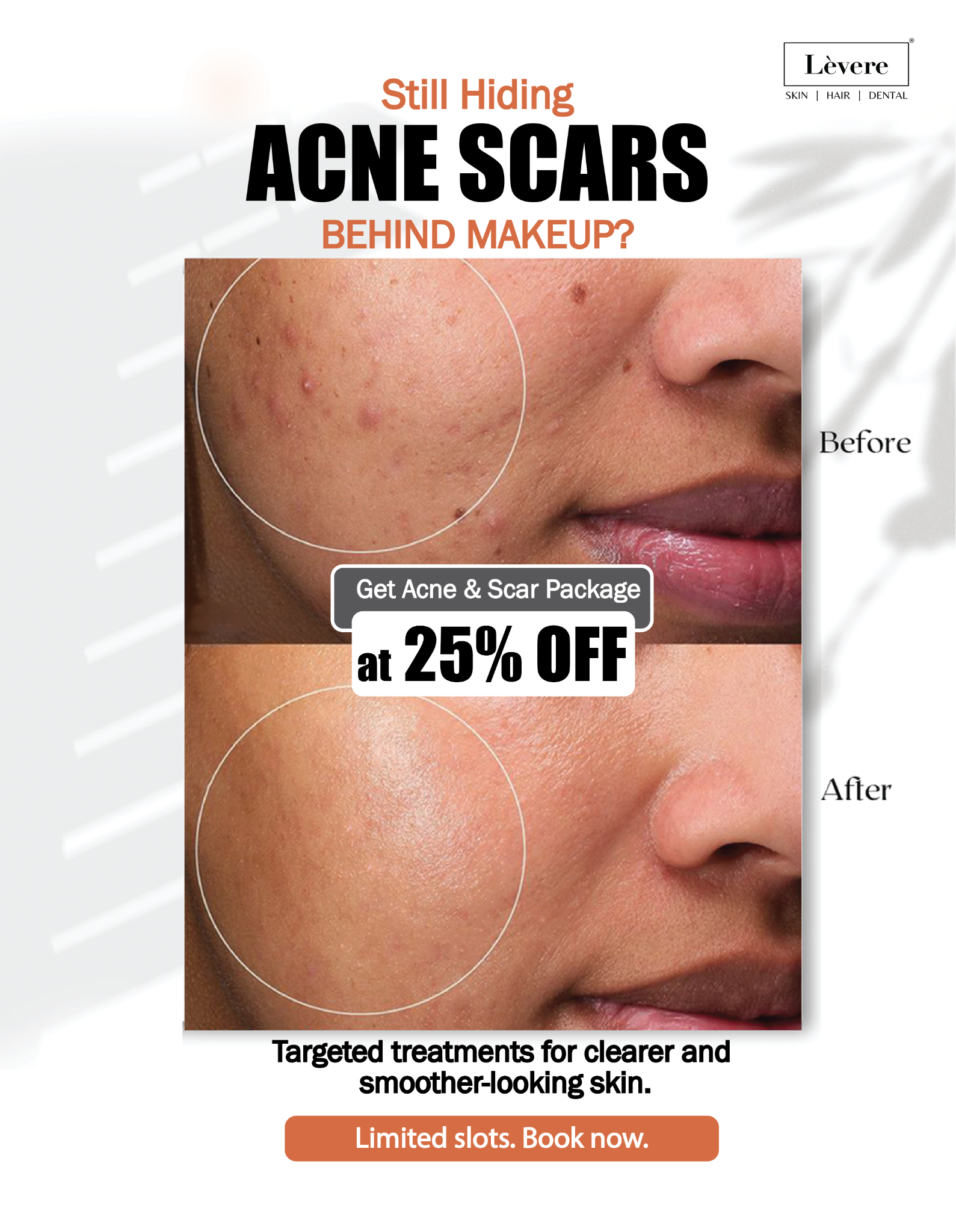 Levere Aesthetic Clinics Facebook ad: Treat Acne Scars, Don’t Hide Them