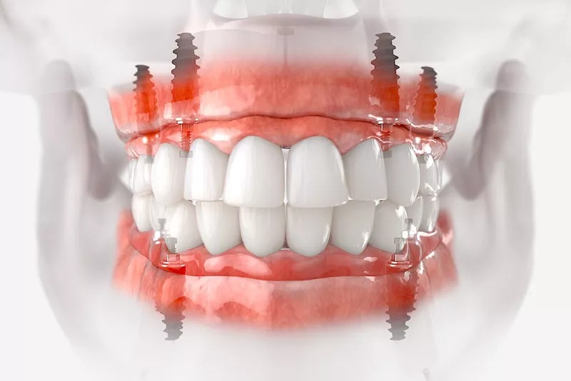 Dental Implants Ireland Facebook ad: Free Consultation