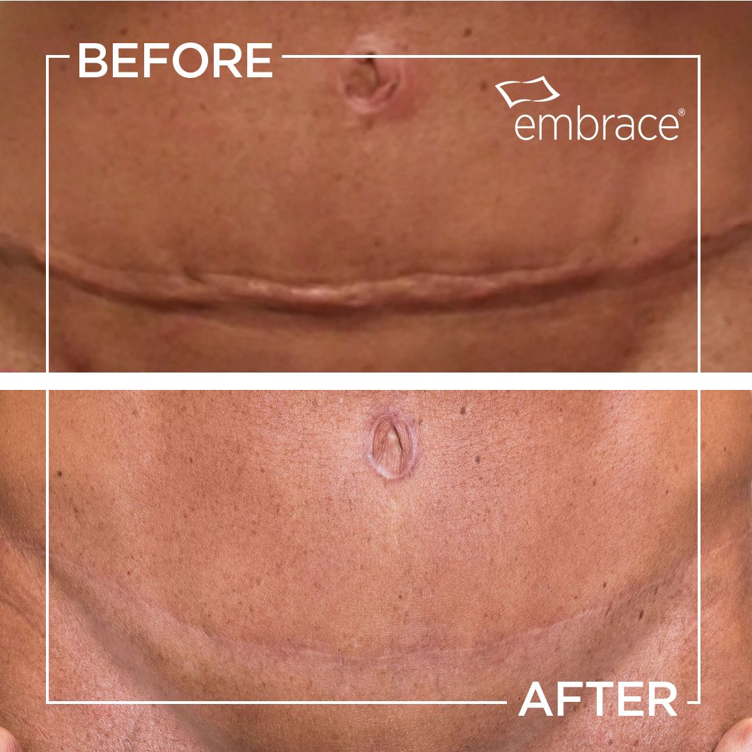 Herbal Action Remedy Facebook ad: Fade old & new scars ASAP