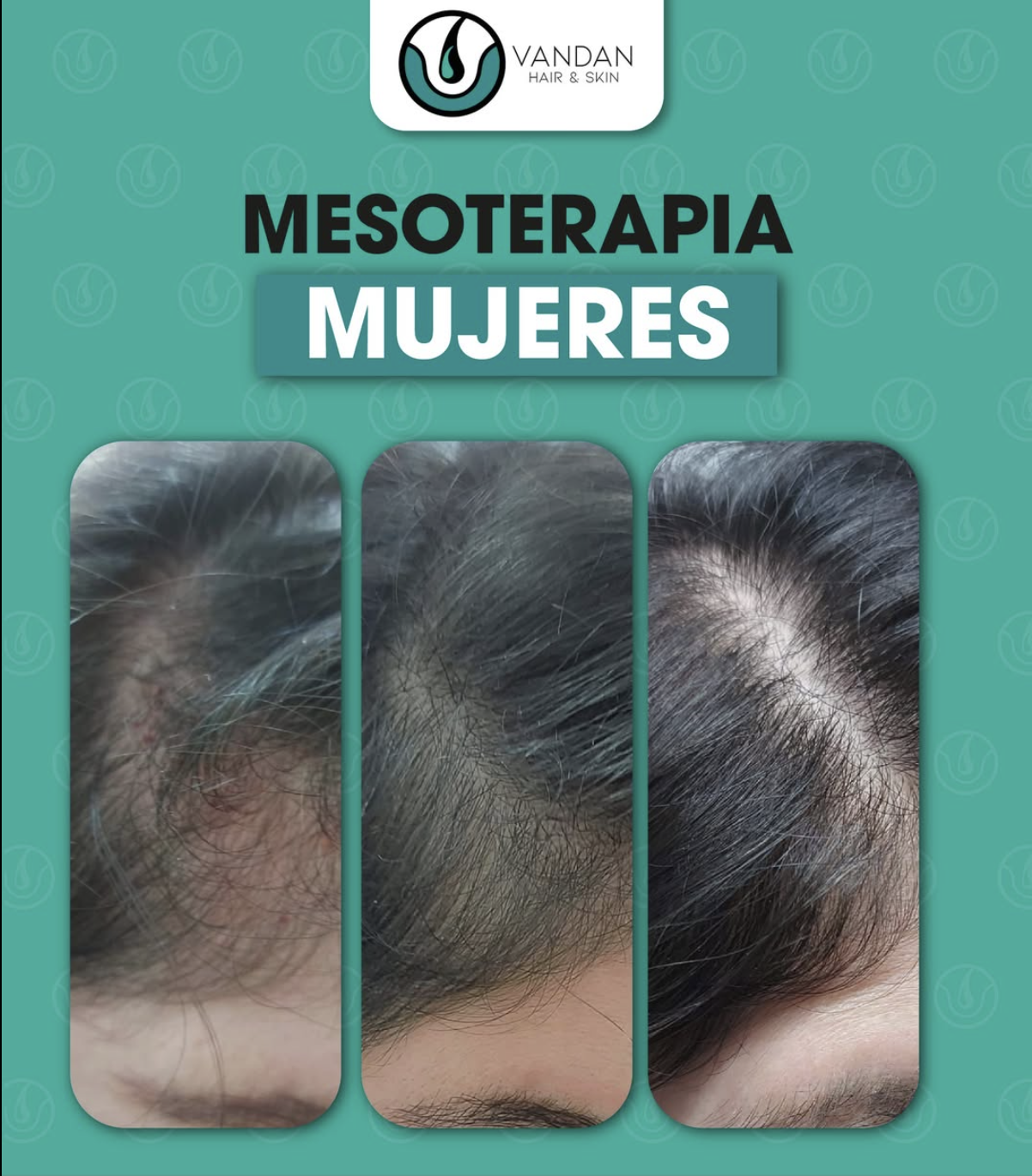 Vandan Hair & Skin Facebook ad: Mesoterapia Capilar