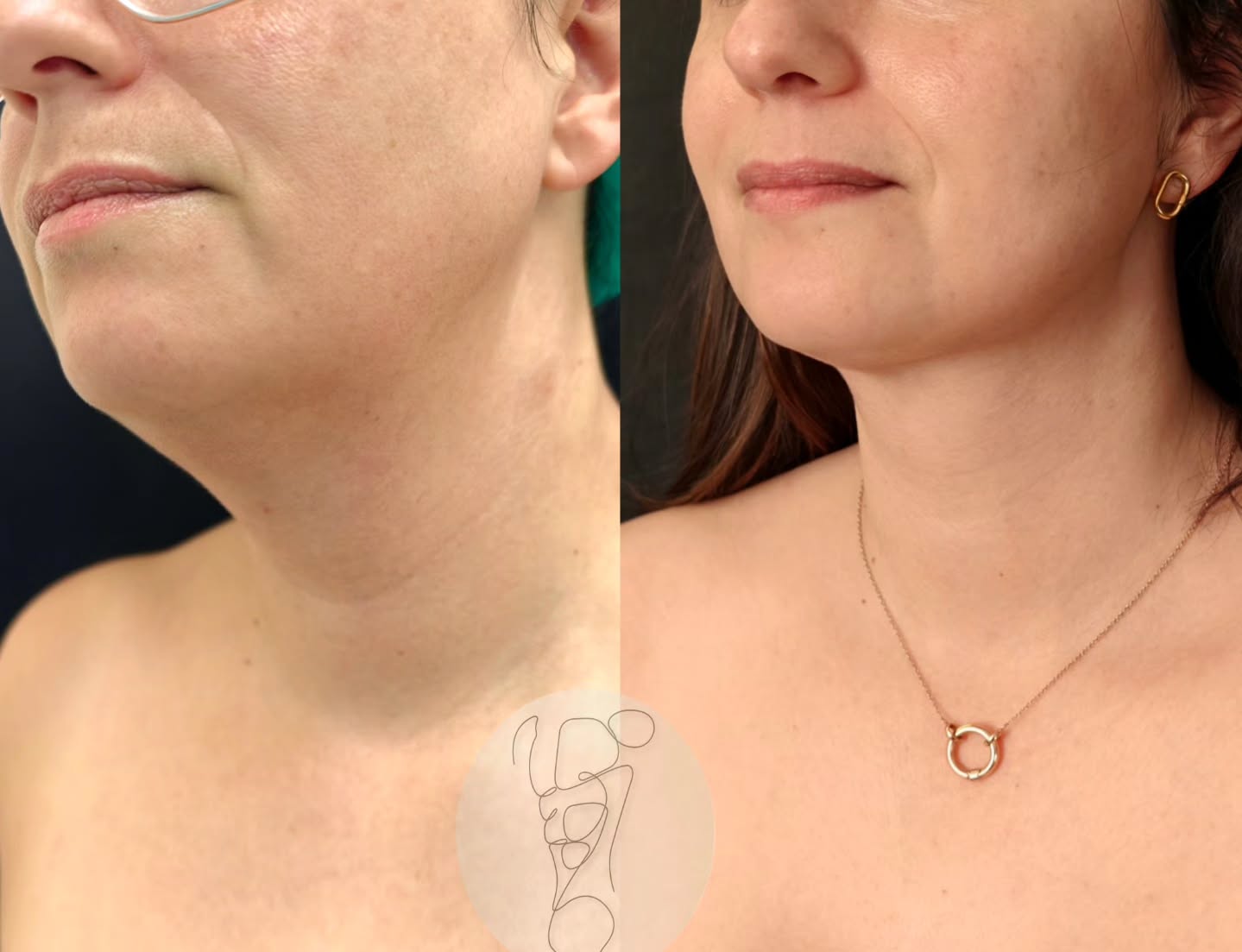 Dra Sofia Carvalho - Cirurgia Plástica Facebook ad: Tratamento da flacidez da face e pescoço com…
