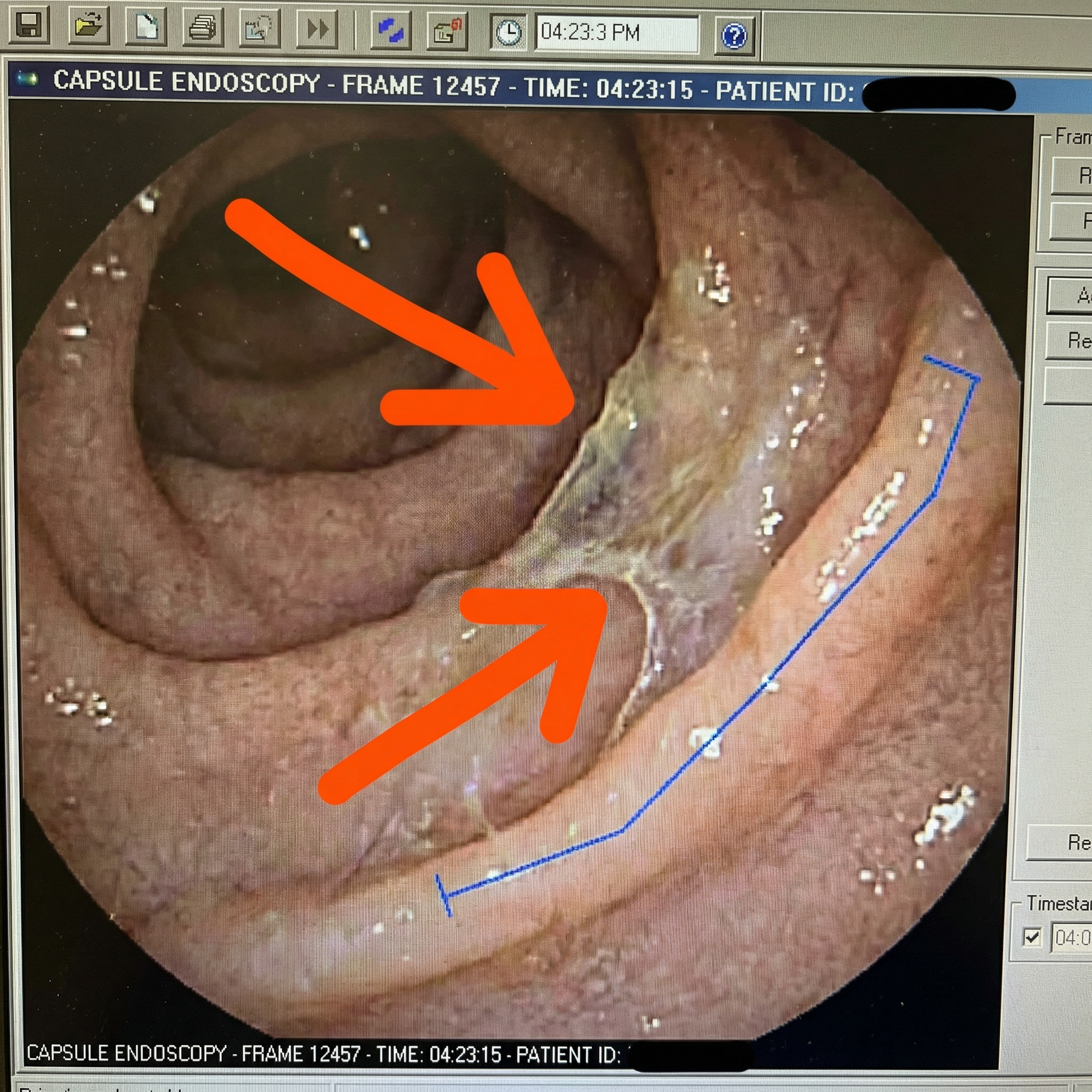 Rachel Moore Facebook ad: Why your SIBO feels untouchable
