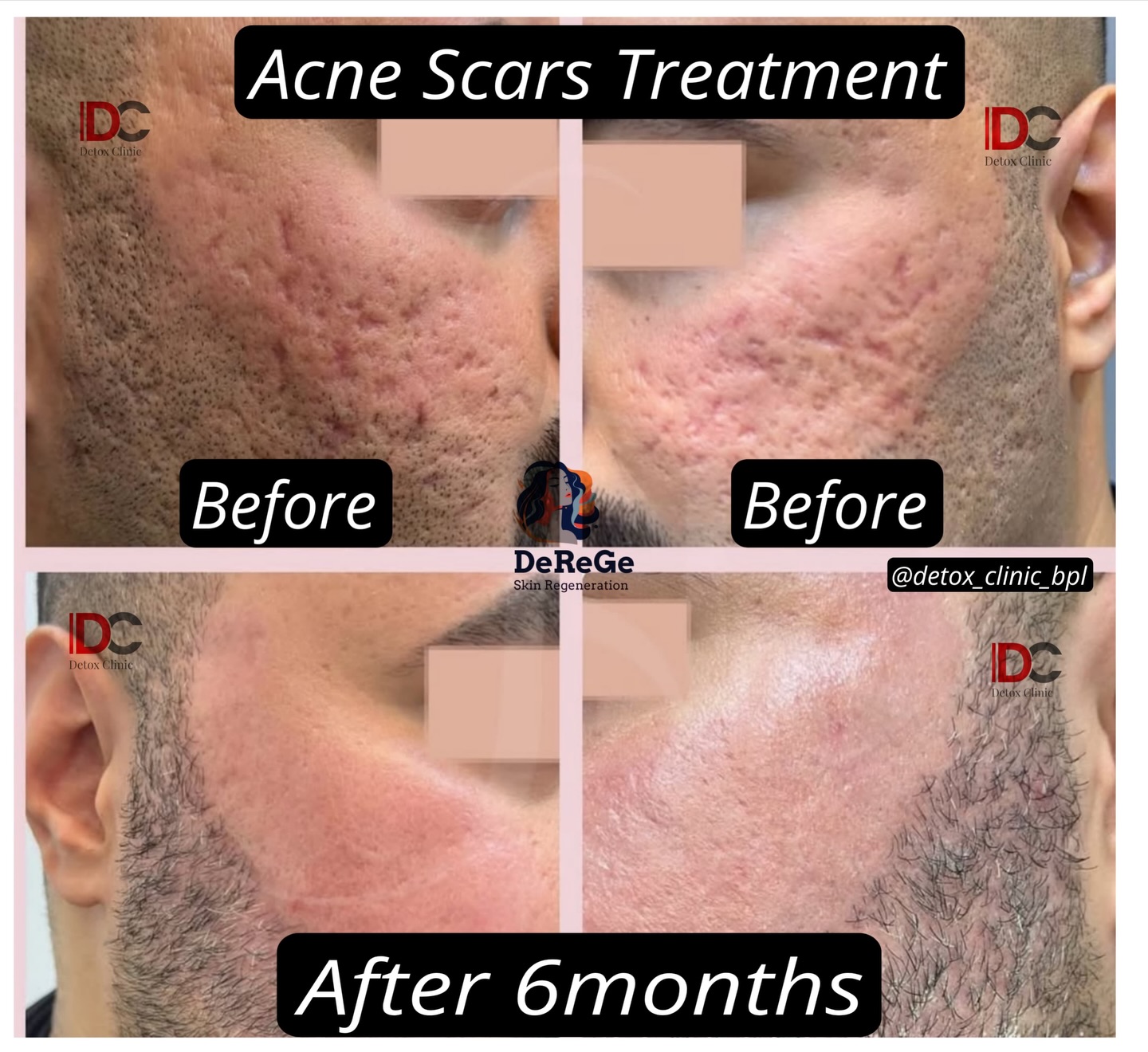 Detox Clinic Facebook ad: Successful Results Of Acne Scars By DeGeRe Treatment