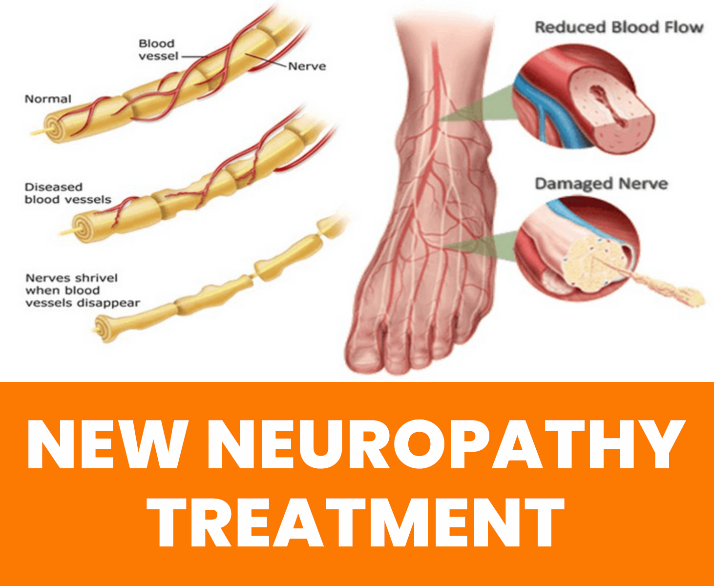Tri-State Neuropathy Centers Facebook ad: NEW: Breakthrough Neuropathy Treatment