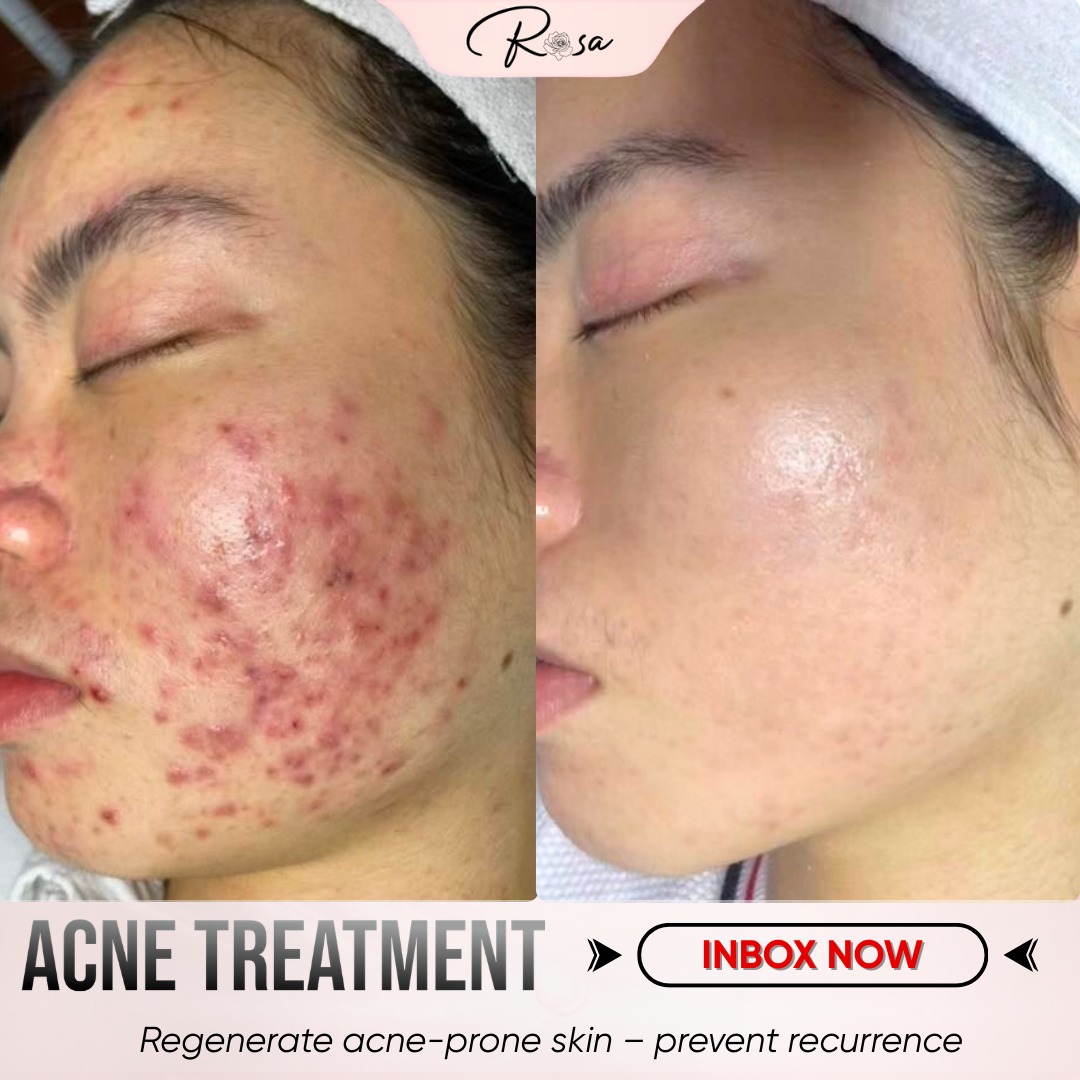 Rosa Skincare Clinic Makati Facebook ad: Persistent breakouts shouldn’t compromise your skin’s health