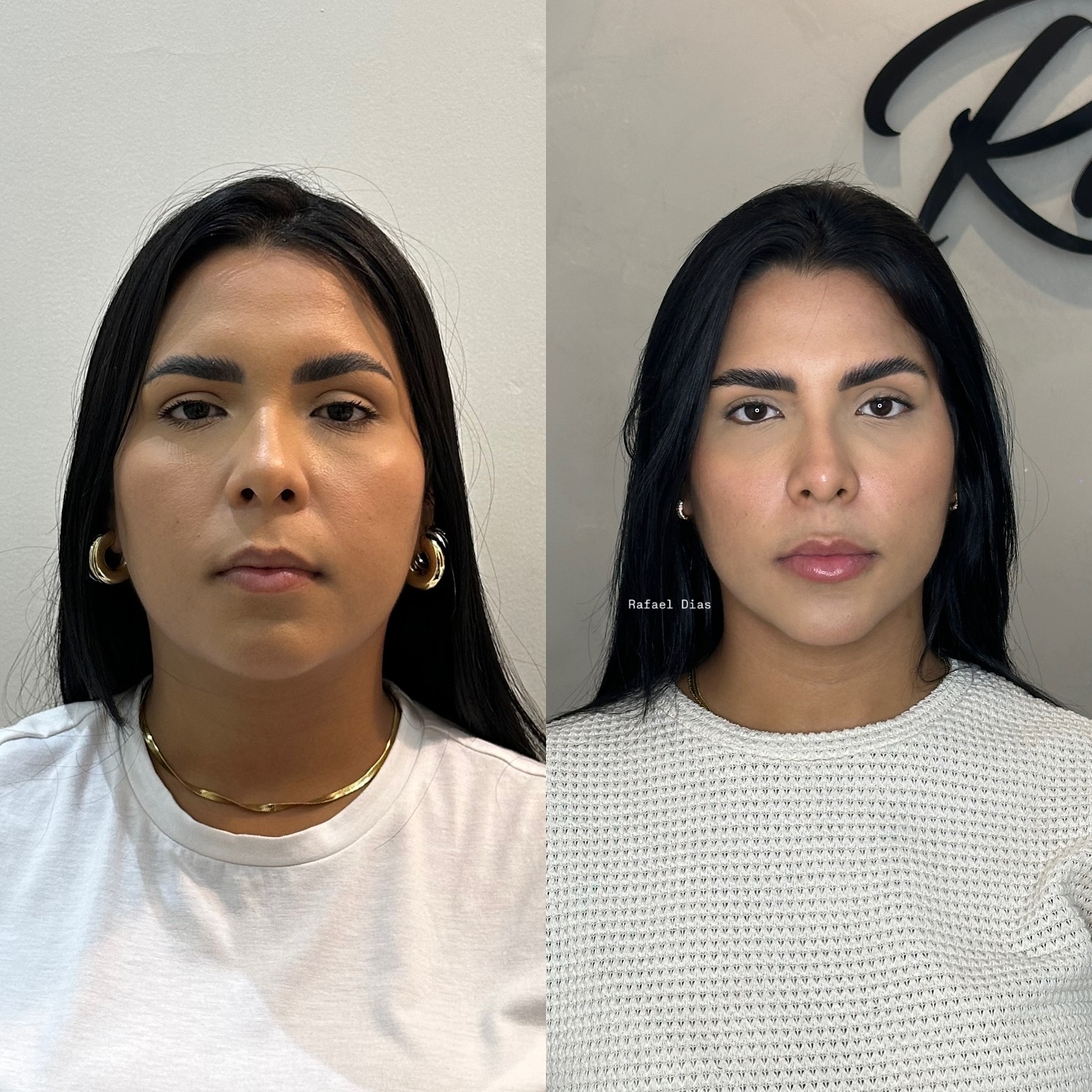 Dr. Rafael Dias/Harmonização facial/Corporal. Facebook ad: Olha esse resultado!