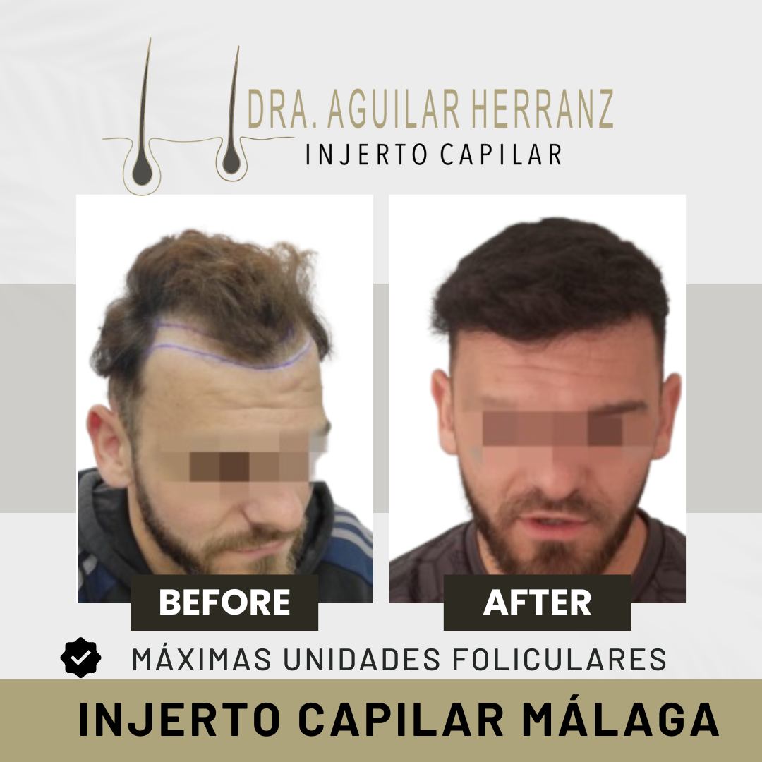 Clinicadraaguilar Facebook ad: Injerto Capilar Málaga