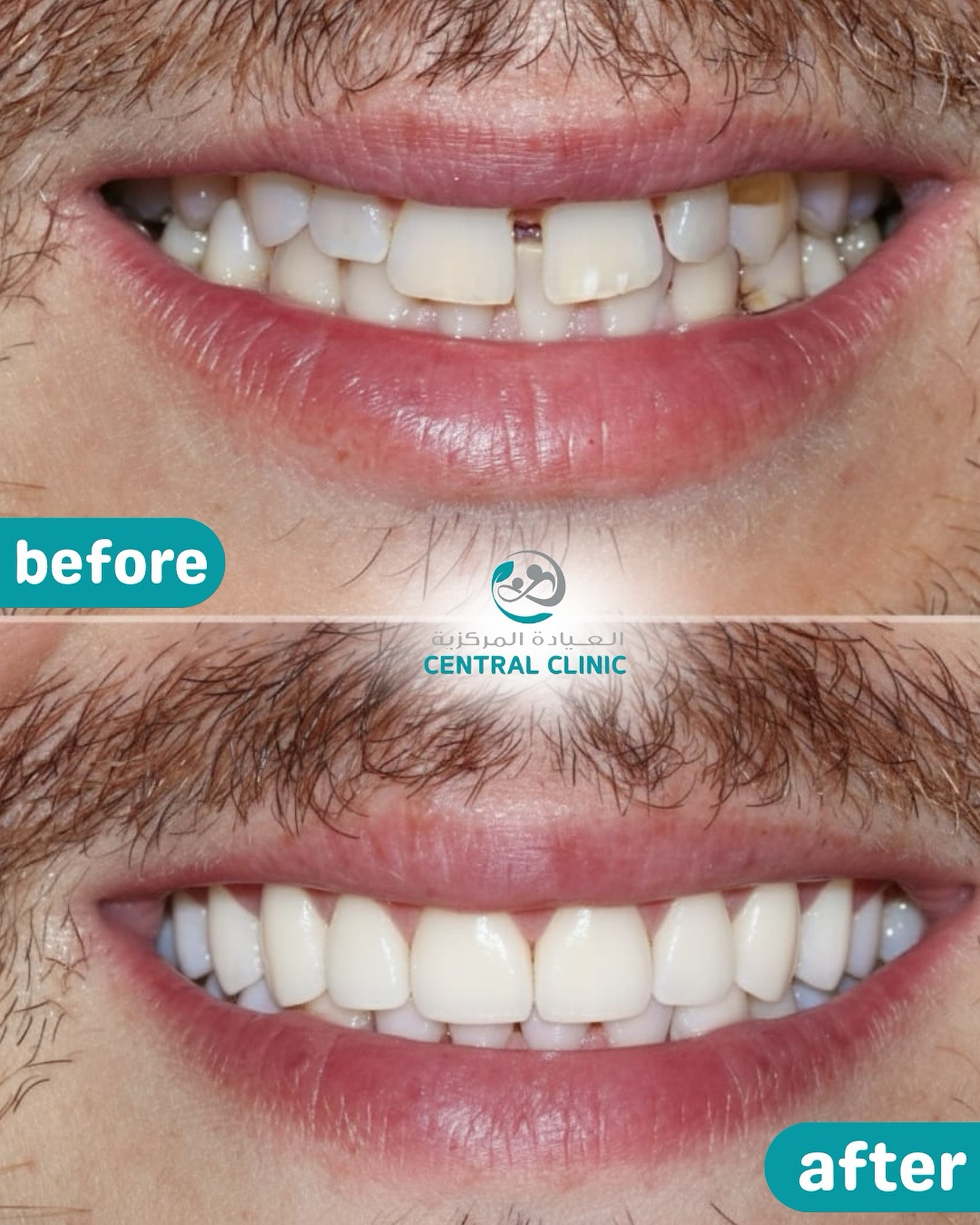 Central Clinic Facebook ad: From gaps & discoloration to a confident, radiant…