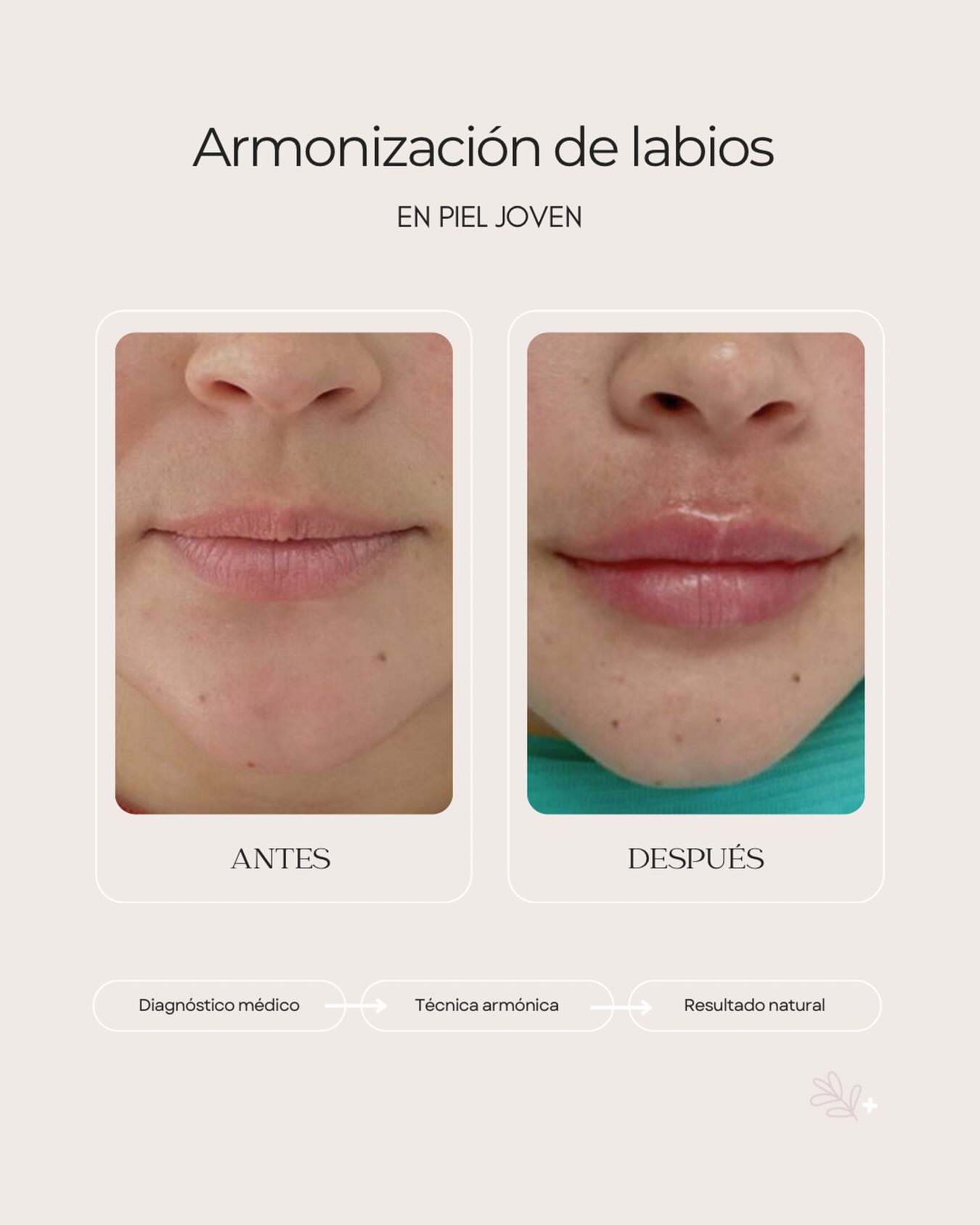 Spa Medical Facebook ad: No todos los labios buscan más volumen.