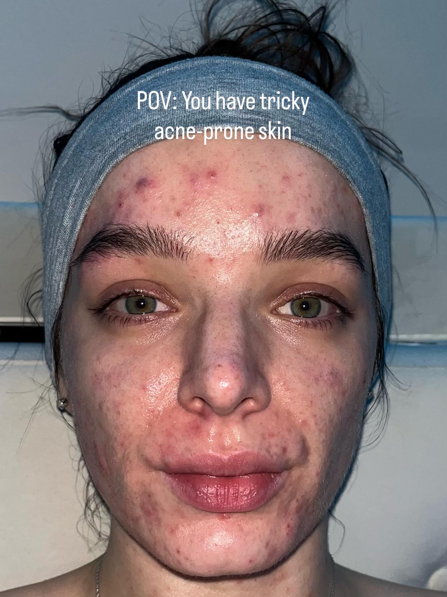Acne Prone Princess Facebook ad