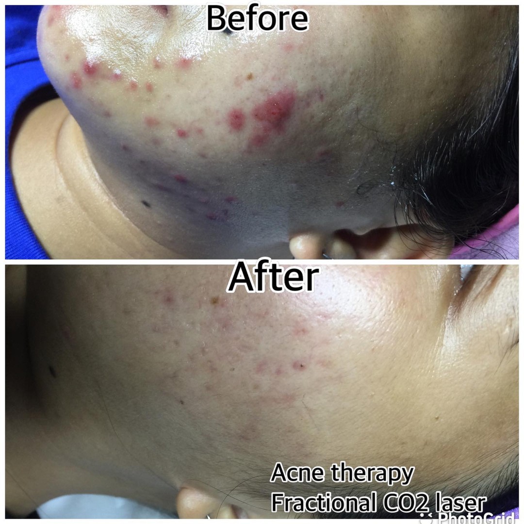 Dermagictouch Wellness Center Facebook ad: Real clients for our scars therapy, fractional laser…