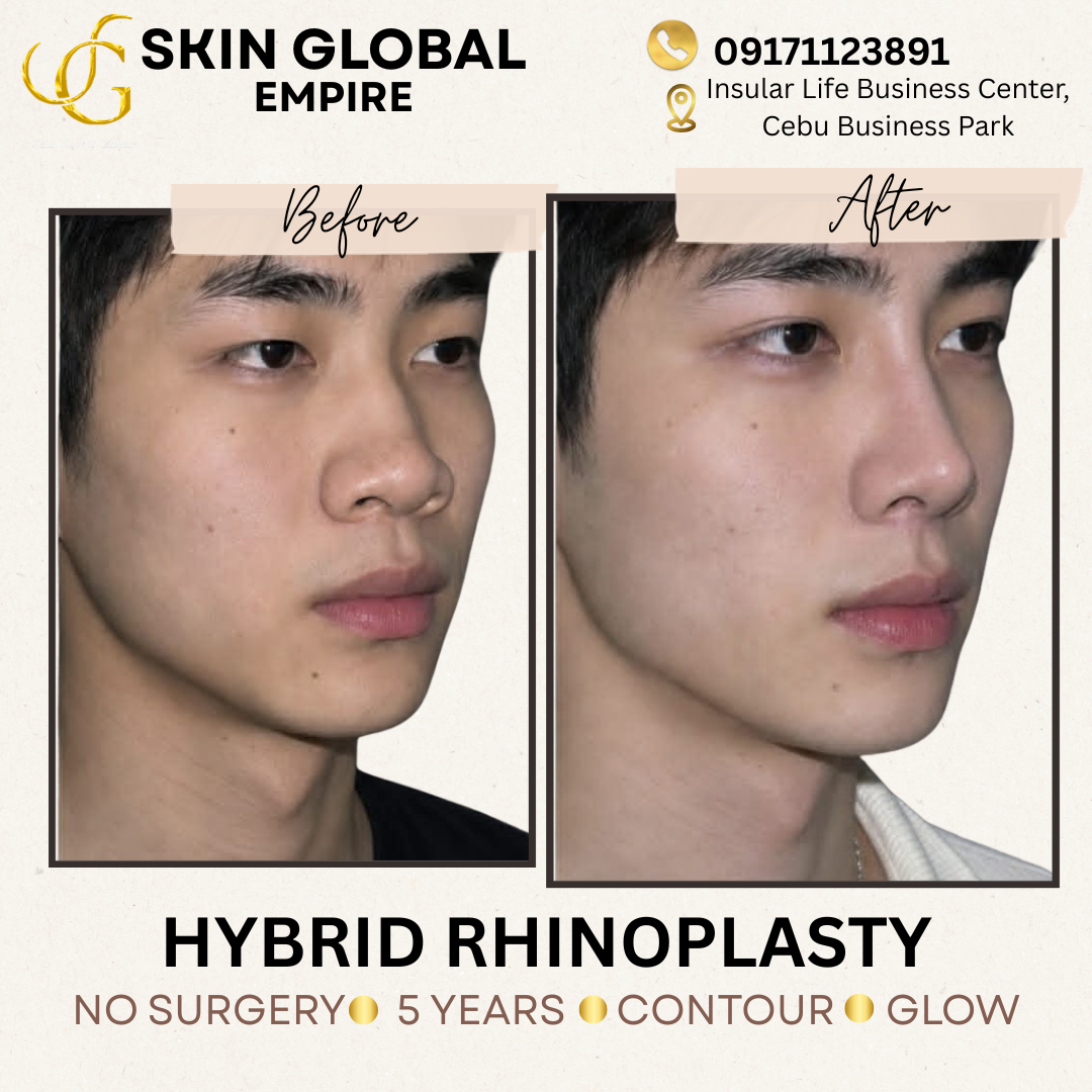 Skin Global Empire Insular CBP Facebook ad: Cebu's premier aesthetic clinic for Non-Surgical Nose…