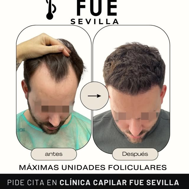 Clínicas Injerto Capilar FUE Facebook ad