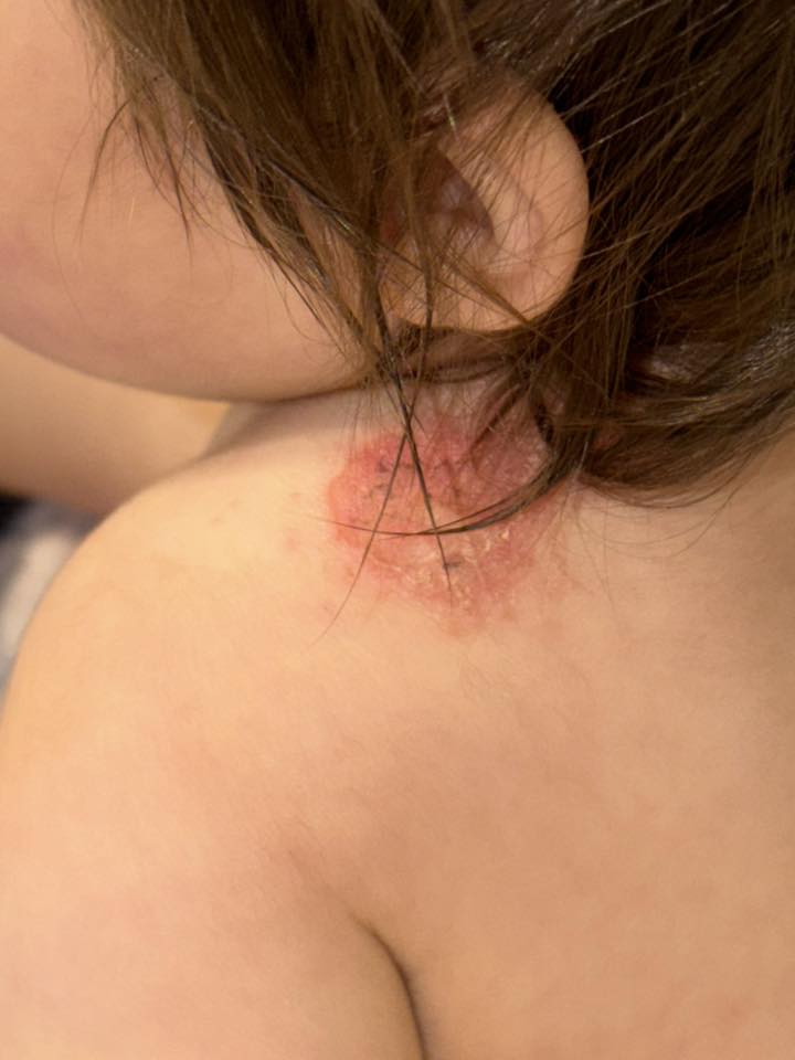Jessica Rossi Facebook ad: Read this if your baby has eczema