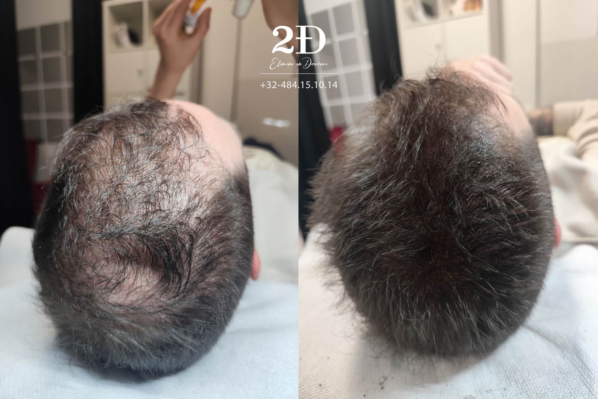 Micropigmentation-bruxelles Facebook ad: Il est temps de camoufler vos zones clairsemées…