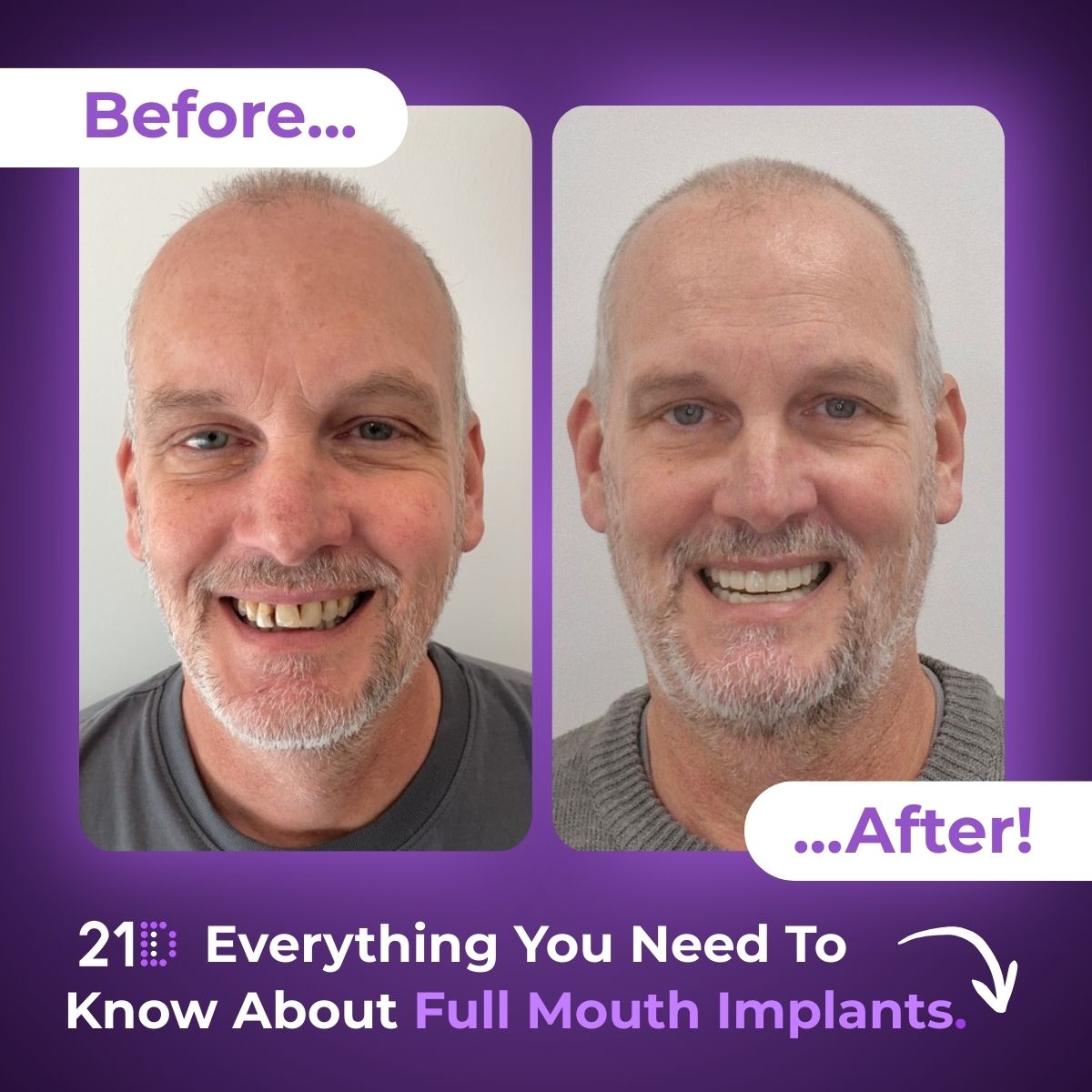 21D: Exclusively Full Jaw Implant Solutions Facebook ad