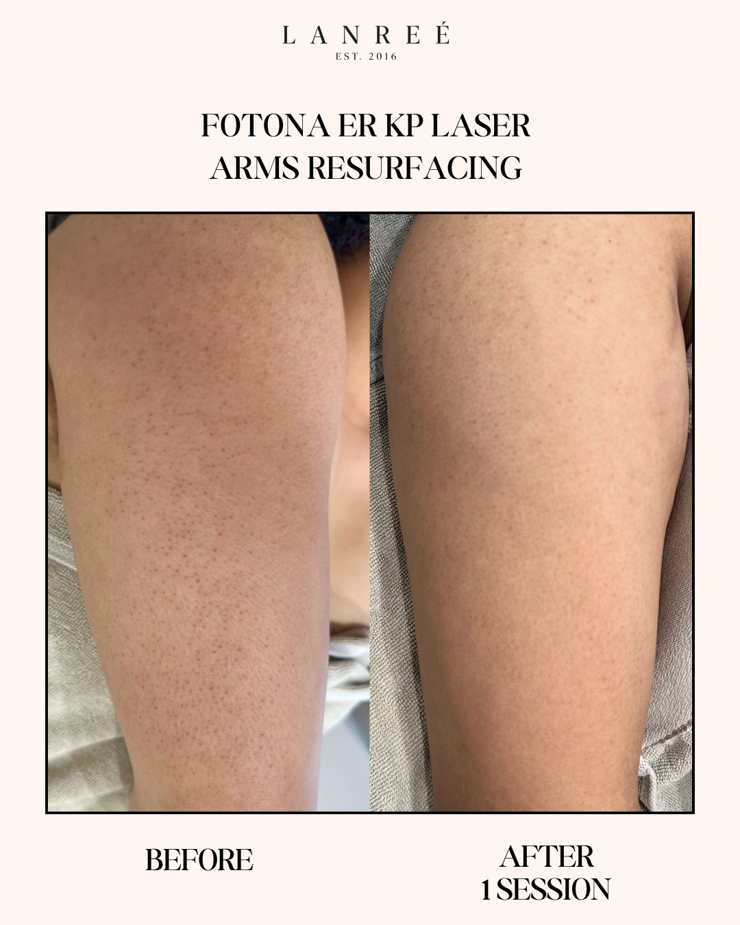 Lanree Aesthetics Facebook ad: Instagram